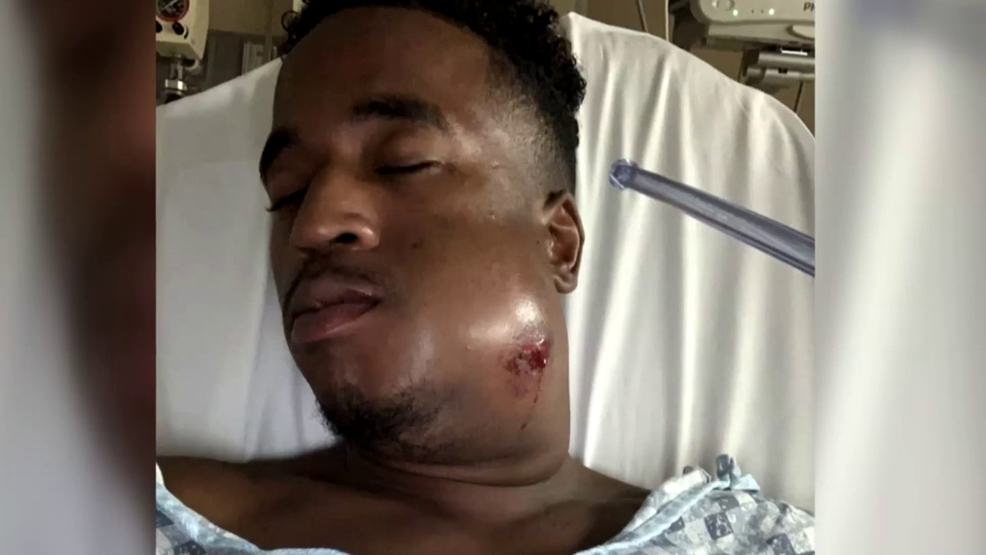 Anthony Evans Broken Jaw By Rubber Bullet 